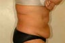 Lipo-abdominoplasty