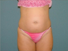 Liposuction