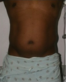 Liposuction