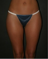 Liposuction