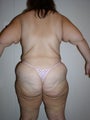 Contouring after massive weight loss