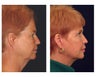 Lower Face & Neck Lift