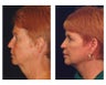 Lower Face and Neck Lift