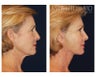 Lower Face and Neck Lift
