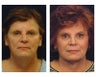 Lower Face and Neck Lift