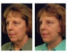 Lower Face and Neck Lift