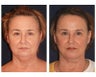 Lower Face and Neck Lift