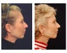 Lower Face and Neck Lift