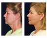Lower Face and Neck Lift