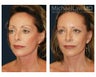Facial Rejuvenation