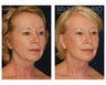 Facial Rejuvenation