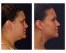 Lower Face and Neck Lift