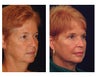 Lower Face & Neck Lift