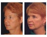 Lower Face and Neck Lift