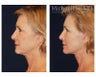 Lower Face and Neck Lift
