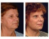 Lower Face and Neck Lift