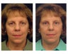 Lower Face and Neck Lift