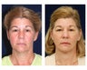 Lower Face and Neck Lift