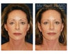 Facial Rejuvenation