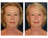 Facial Rejuvenation