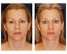 Lower Face and Neck Lift