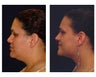 Lower Face and Neck Lift