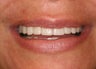 Smile makeover with Lumineers and Invisalign