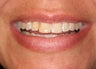 Smile makeover with Lumineers and Invisalign