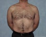 Male Breast Reduction