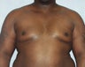 Male Breast Reduction/Gynecomastia