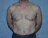 Male Breast Reduction