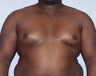 Male Breast Reduction/Gynecomastia