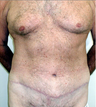 Abdominoplasty