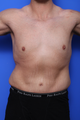 Abdominoplasty