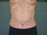 Tummy Tuck