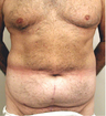 Abdominoplasty