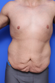 Abdominoplasty