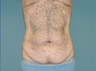 Tummy Tuck