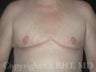 Transgender (F-M) mastectomies ("top surgery")