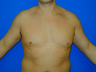 Male Breast Reduction