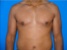Male Breast Reduction