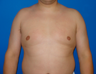 Male Breast Reduction