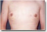Male Breast Reduction/Gynecomastia