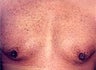 Male Breast Reduction/Gynecomastia