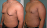 Gynecomastia Surgery