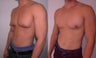 Gynecomastia
