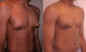 Gynecomastia