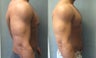 Gynecomastia Surgery