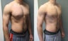Gynecomastia