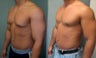 Gynecomastia New York